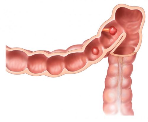 Полипы в кишечнике