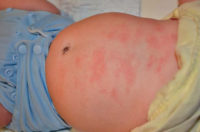 Заговоры от аллергии у малыша thumbnail