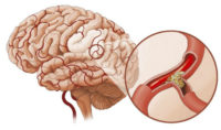 Атеросклероз сосудов головного мозга лечение клевером